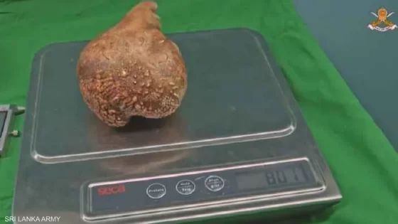 الإعلان عن استئصال أكبر وأثقل حصوة كلوية بالعالم