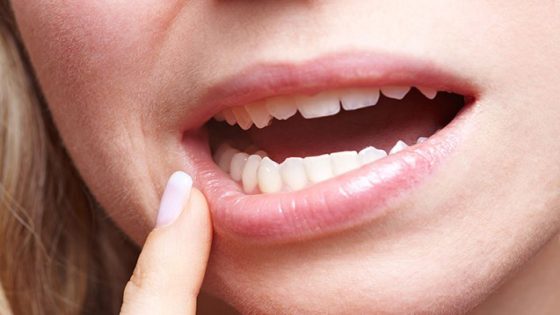 جفاف الفم.. علامة “حمراء” على 5 أمراض خطيرة
