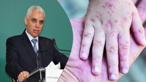اللجنة العلمية بوزارة الصحة تناقش الإجراءات الوقائية في مواجهة جدري القردة