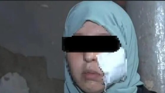 ثلاث سنوات سجنا لشابة شوّهت وجه فتاة بدافع الغيرة في بركان